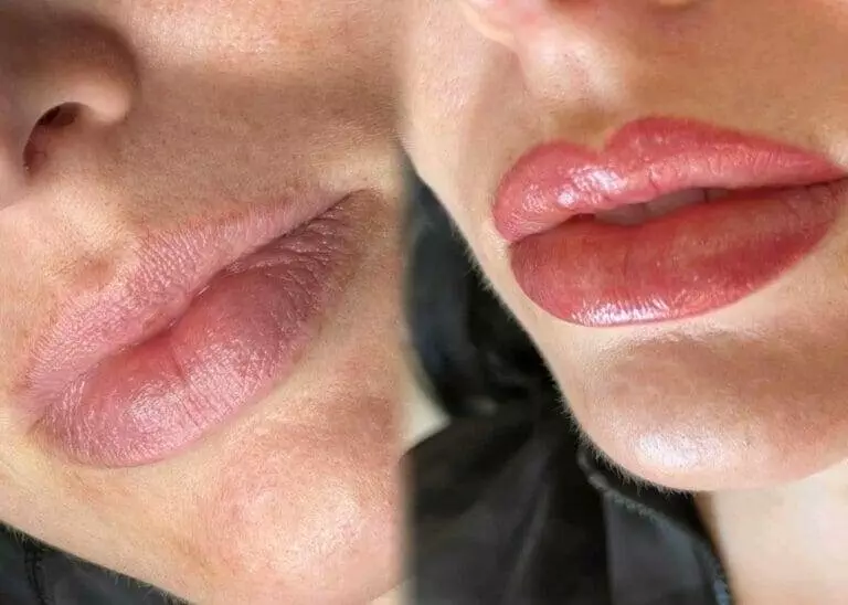 Lip injections transformation services.