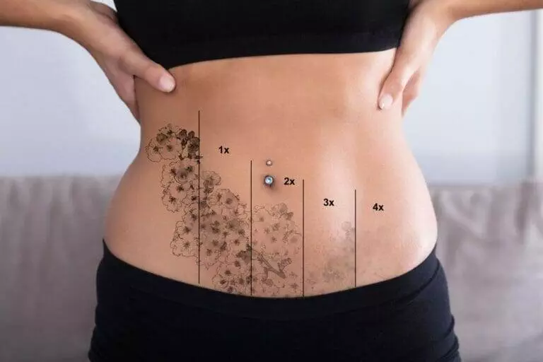 A woman's stomach with tattoos undergoes removal.